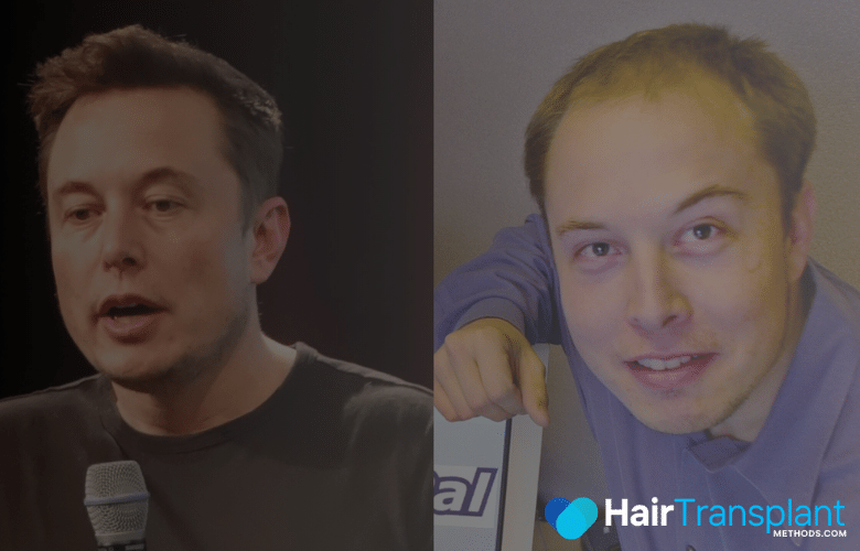 Elon Musk Hair Transplant
